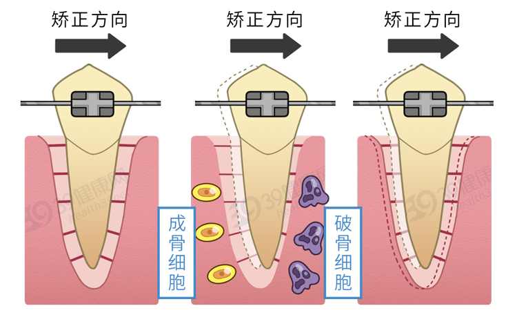 为什么只要戴牙套，牙齿就可以恢复得很整齐？生动展示矫正过程