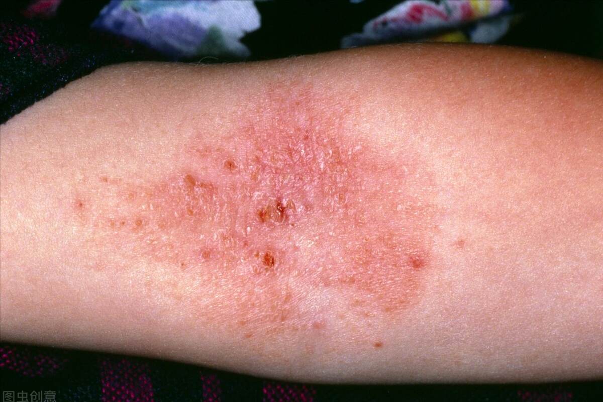 为什么湿疹反反复复,周而复始的发作?