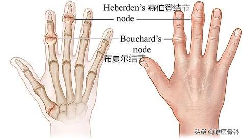 手部关节疼痛、肿胀、晨僵？你可能得了“手骨性关节炎”