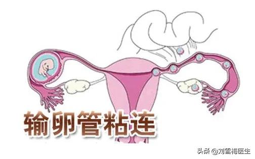 输卵管造影疼吗?做完多久可以要孩子?你想问的这里都有答案