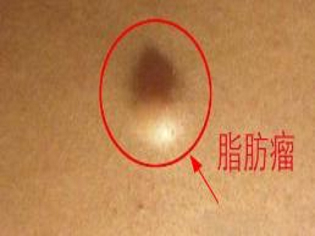 脂肪瘤怎么去除？这些小窍门帮你轻松应对