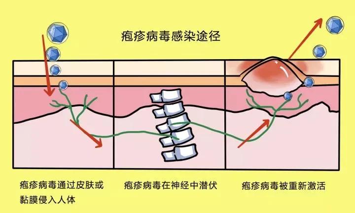 单纯疱疹病毒可以在人与人之间会通过飞沫,唾液和疱液(疱疹里面的液体