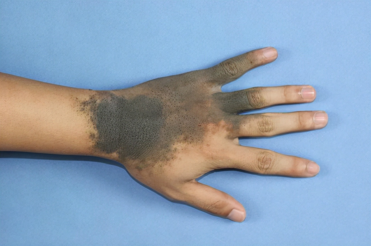 激光vs手术,哪个比较好?