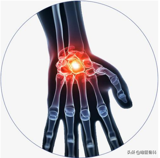 手部关节疼痛、肿胀、晨僵？你可能得了“手骨性关节炎”
