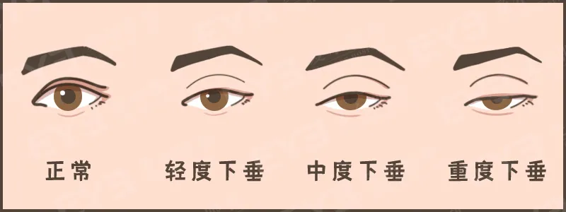 眼皮没力氣，不是“睡不醒”，而是“上睑下垂”这种病