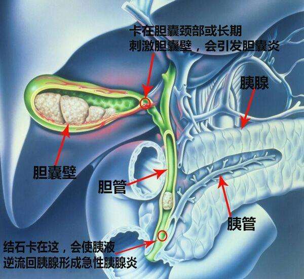 胆囊结石严重吗？多大需要治疗？看完这篇文章你就清楚了