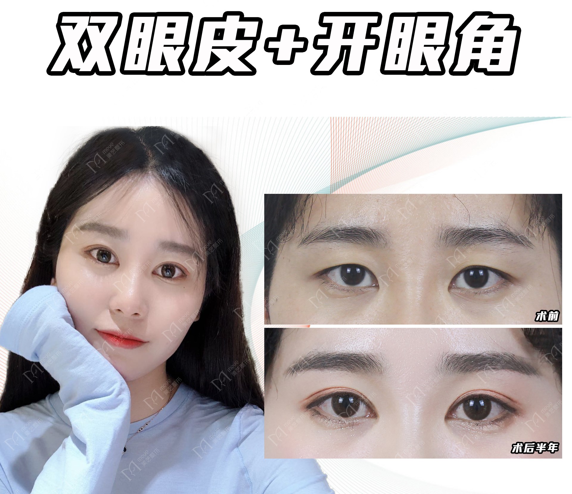 平扇,开扇形双眼皮都属于自然款,如何选择不后悔?