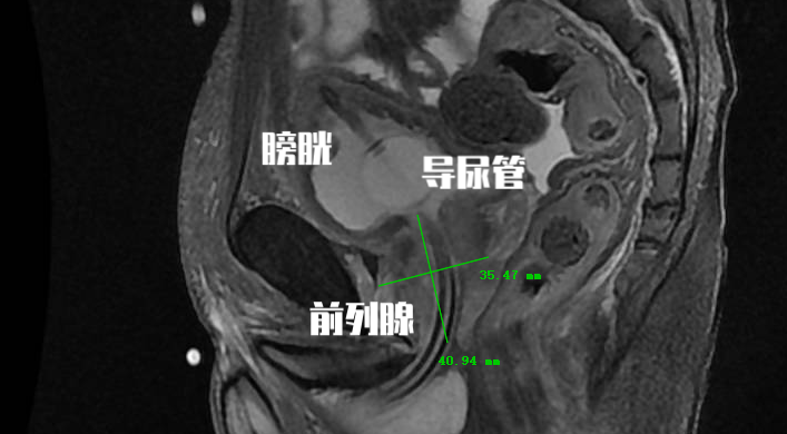 前列腺增生有手术指征，多次要求手术，但为什么医生总是拒绝？