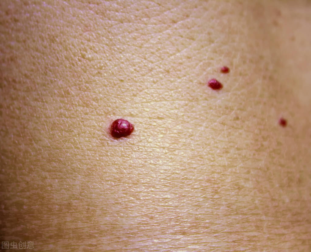 血管瘤的症状图片(孩子身上长着血红色疙瘩是什么) - 赤虎壹号