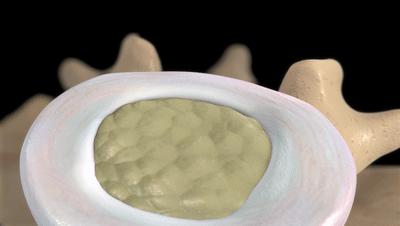 6个缓解腰椎间盘突出的伸展运动，避免7个训练，强壮腰椎不踩雷