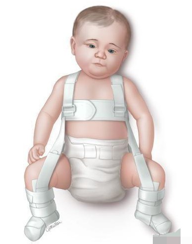 正确婴儿腿纹图片(宝宝腿纹不对称) - 赤虎壹号