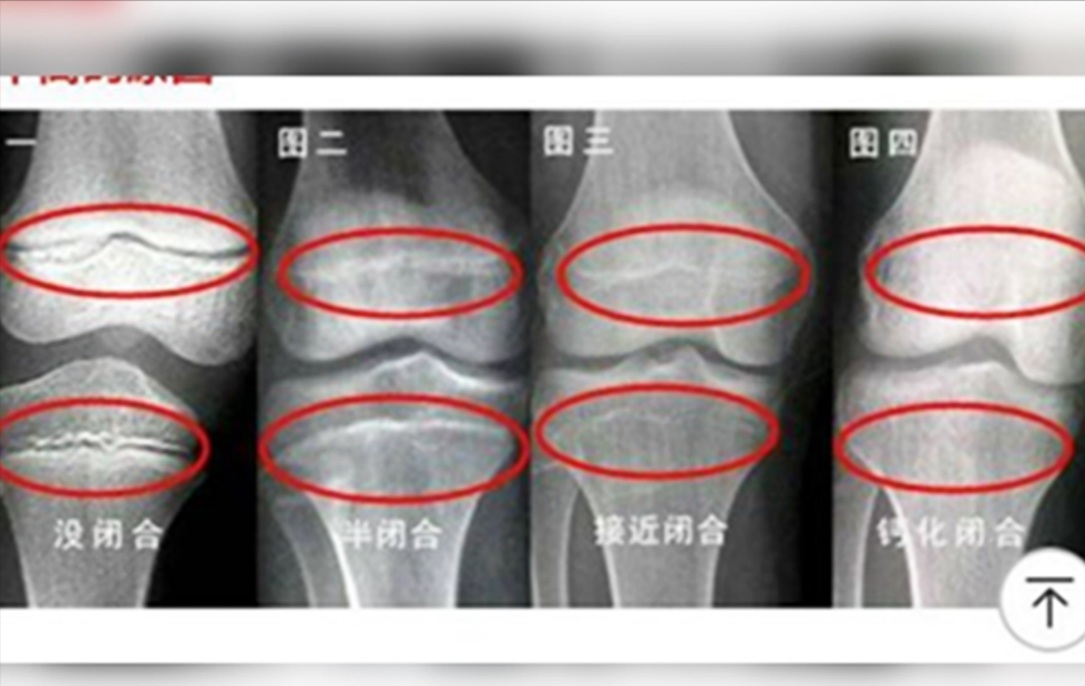 增高针有什么副作用？矮个子，打完增高针真的能“获救”吗？