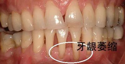 牙龈萎缩导致牙根外露？科学应对与有效治疗方法