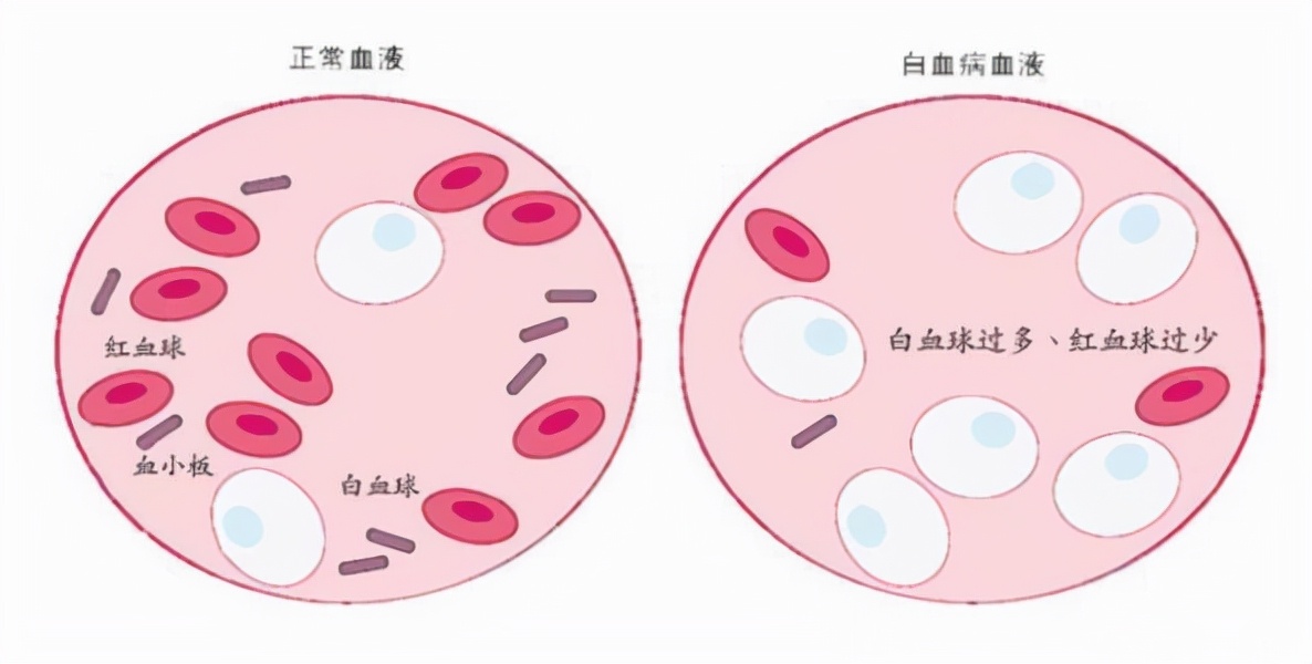 为何现在孩子易得白血病？白血病对人体有哪些危害？发病率多少？