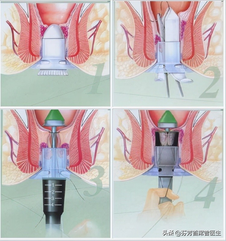 痔疮发作要做手术，到底是传统手术好，还是选择PPH手术？