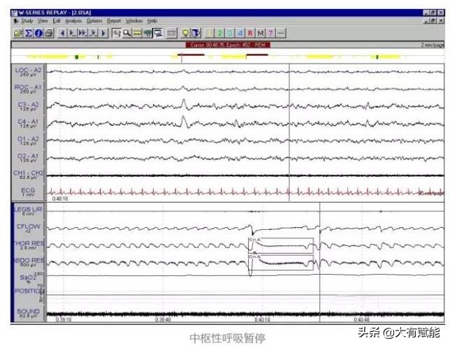 全面解析睡眠呼吸暂停