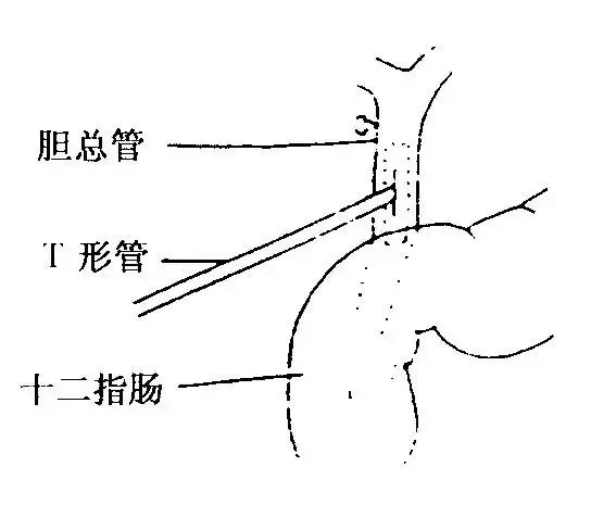t管造影多少钱聊聊长得像字母