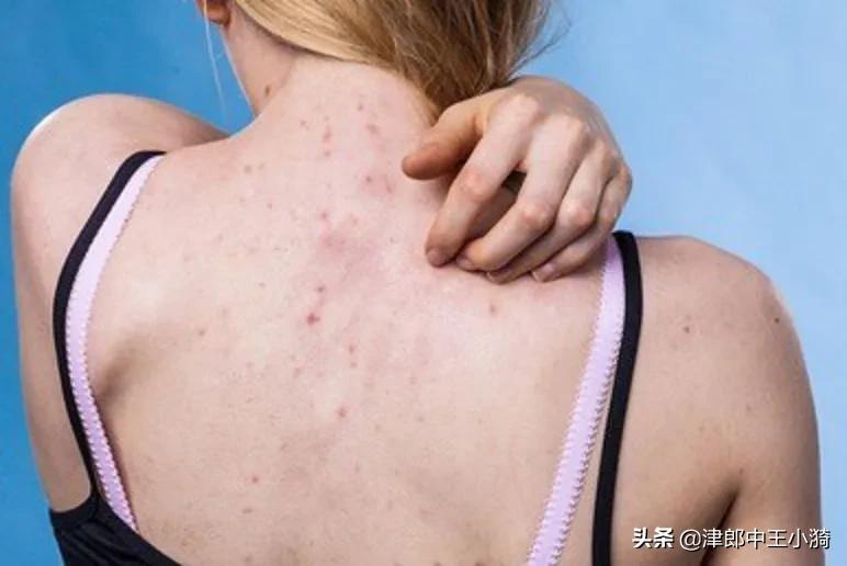 体内有湿气？4个表现帮您判断