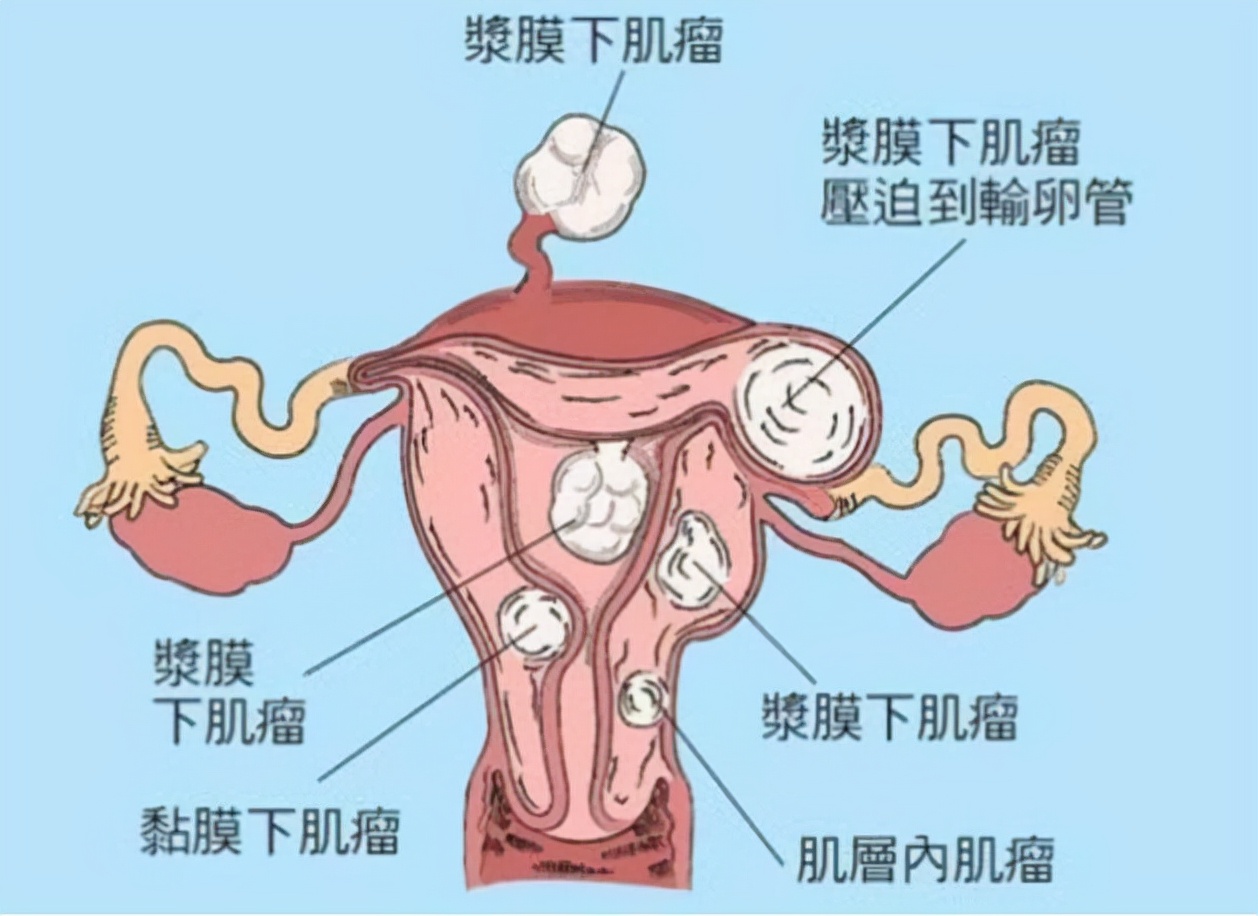 子宫肌瘤成因揭秘：女性为何更易患病