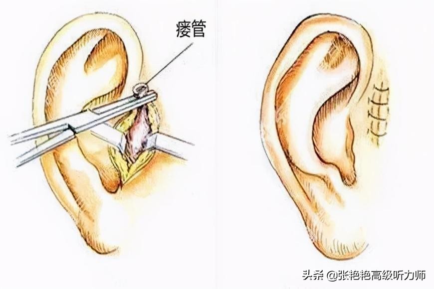 这些都是有福气的象征？耳仓、拴马桩耳、耳垂大...是真的吗