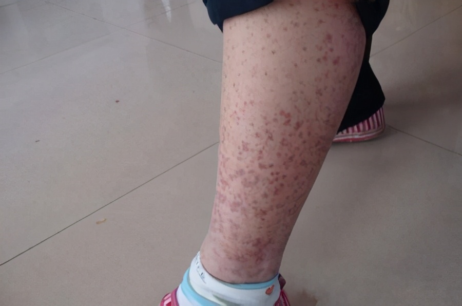 过敏性紫癜患儿只能躺着不动吗?