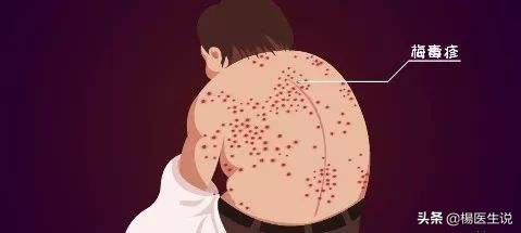 梅毒能治好吗要多少钱梅毒到底能不能治愈