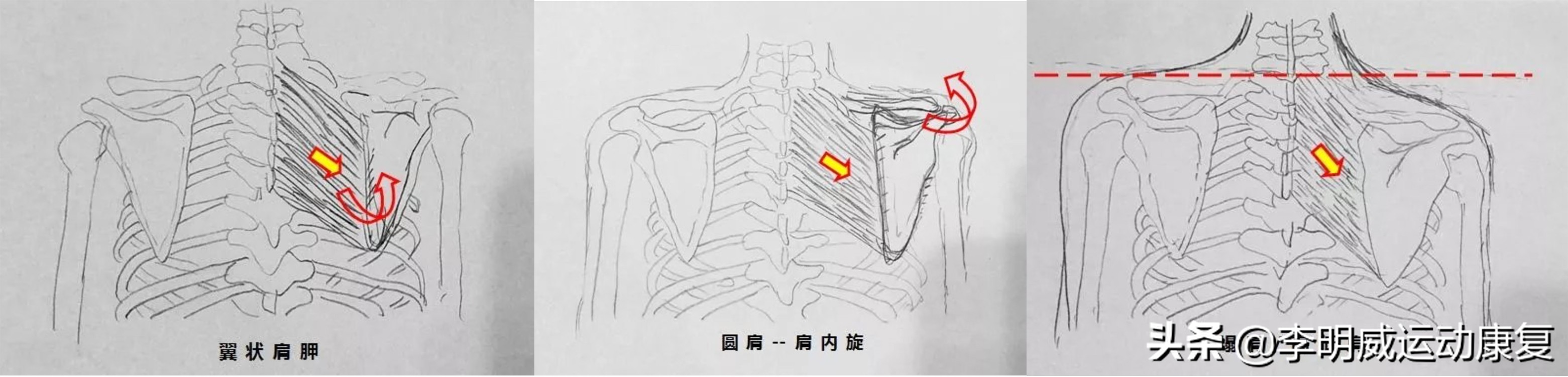 后背、肩胛骨、脊柱缘疼痛，应该如何自我康复？
