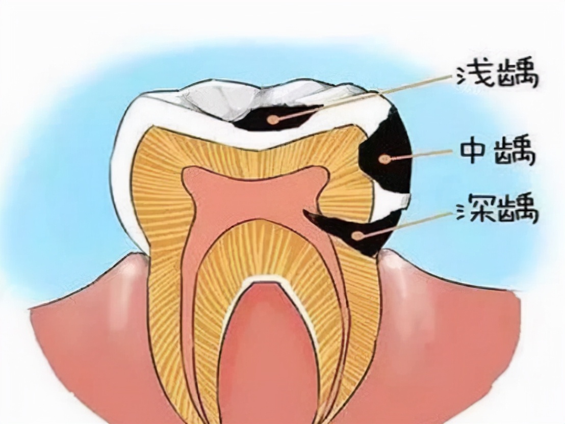 牙疼太痛苦，可是你知道有一种药，是专门预防龋病的吗？