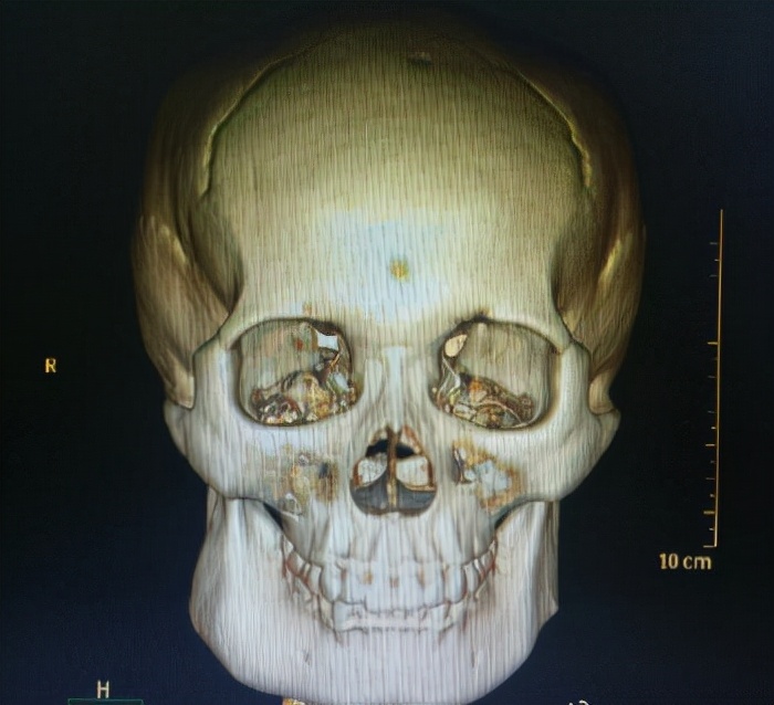 面部不对称的脸应该如何改善？