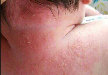 宝宝热出一身痱子,婆婆竟然说不准吹空调!婴儿热痱该如何护理?