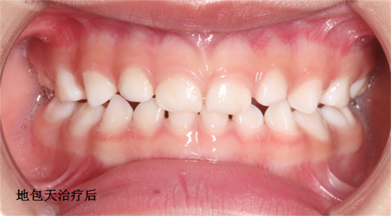 地包天、龅牙，孩子好自卑，牙科医生：别错过最佳矫正时机