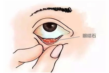 眼结石,主要是指结膜结石,多见于成年人,老年人及沙眼和慢性结膜炎