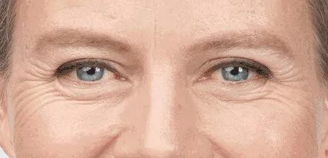 鱼尾纹,抬头纹,法令纹,人生进阶时刻,你真的没"纹"题吗