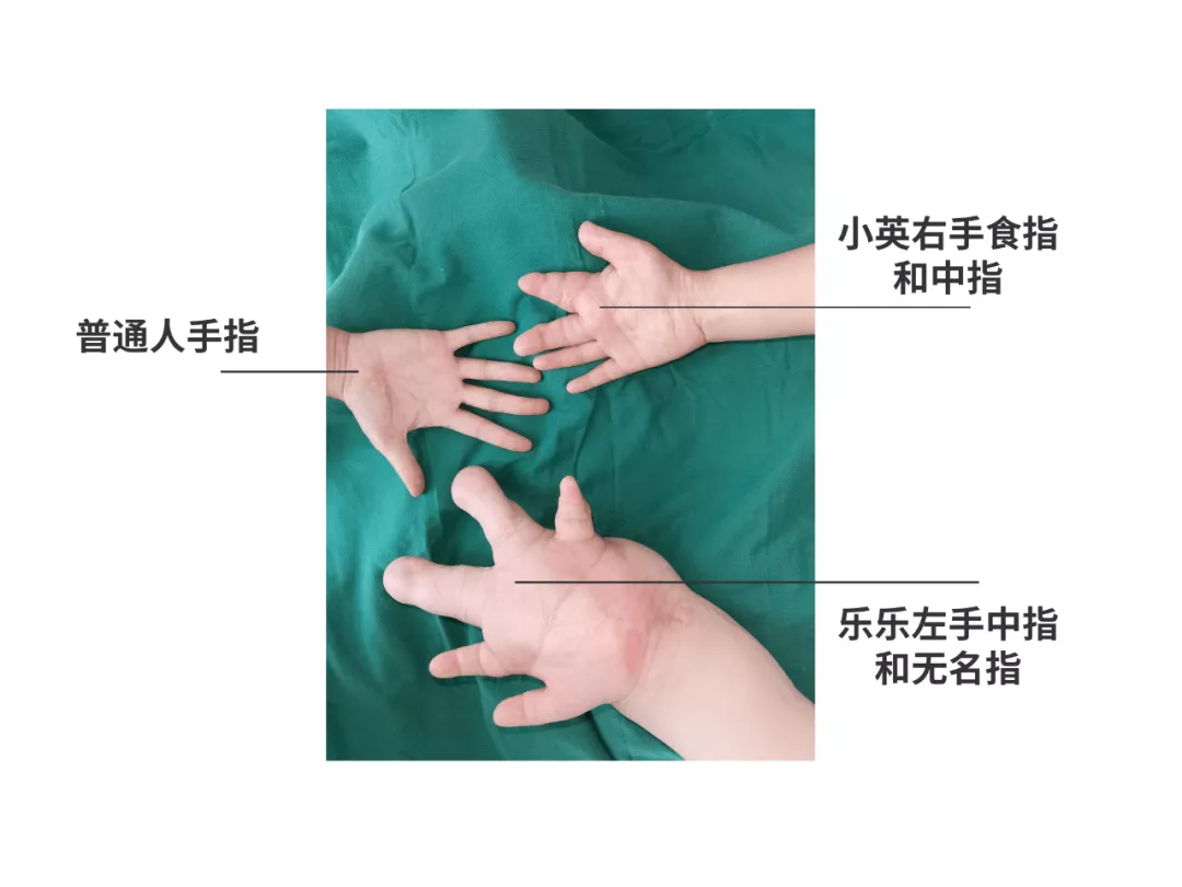 得了这病，12岁男孩手指比香蕉还粗！7种常见的手部畸形，家长们要注意