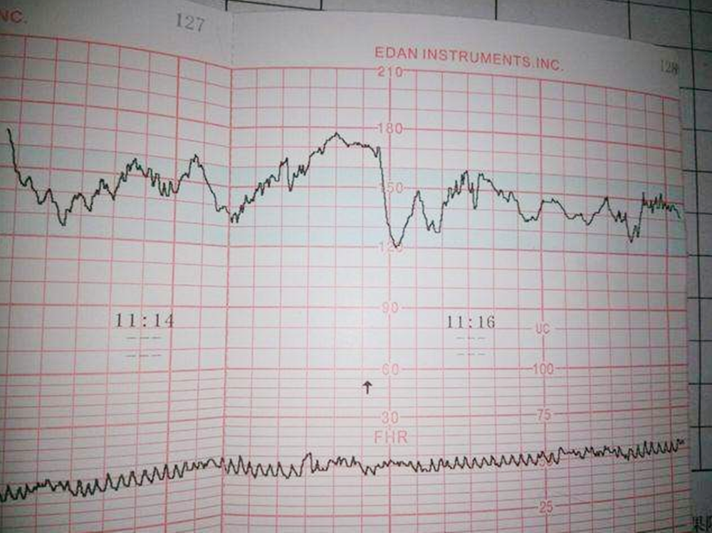 这几个数据看懂,自己就能了解胎儿的健康情况
