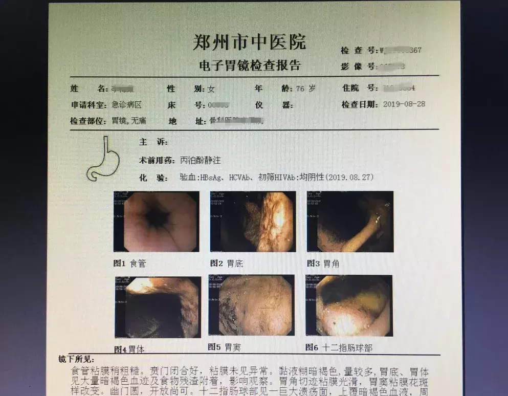 76岁老人急性胃出血1500ml,用了这种“武器”,马上止血