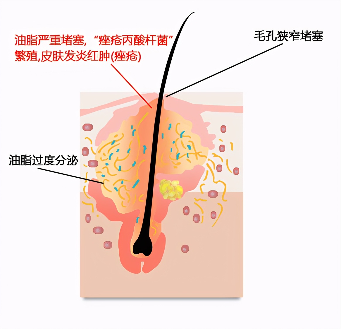 祛痘，刷酸靠谱吗？刷酸跟吃药，如何选择？