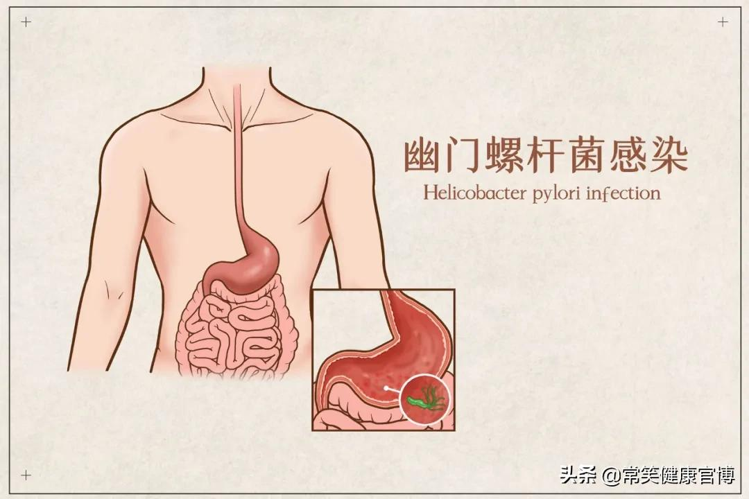 哎喲胃!檢查幽門螺桿菌,哪種方法最準確?