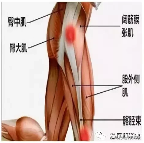 髂胫束综合征，知否？
