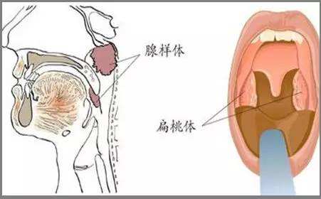 手术治疗儿童腺样体肥大，也未必一劳永逸，该怎么办？