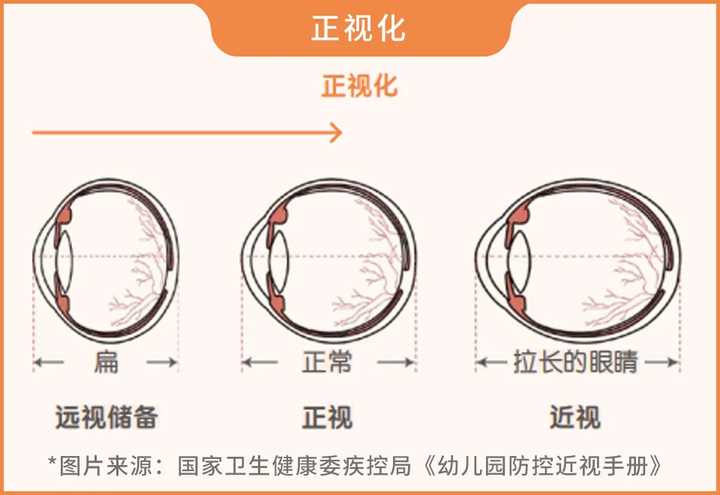 叶黄素？护眼贴？ok镜？近视真的可以治好吗？