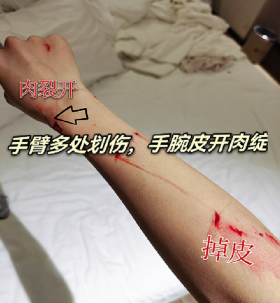 洗澡时玻璃门突然爆炸,手腕皮开肉绽伤口可怖