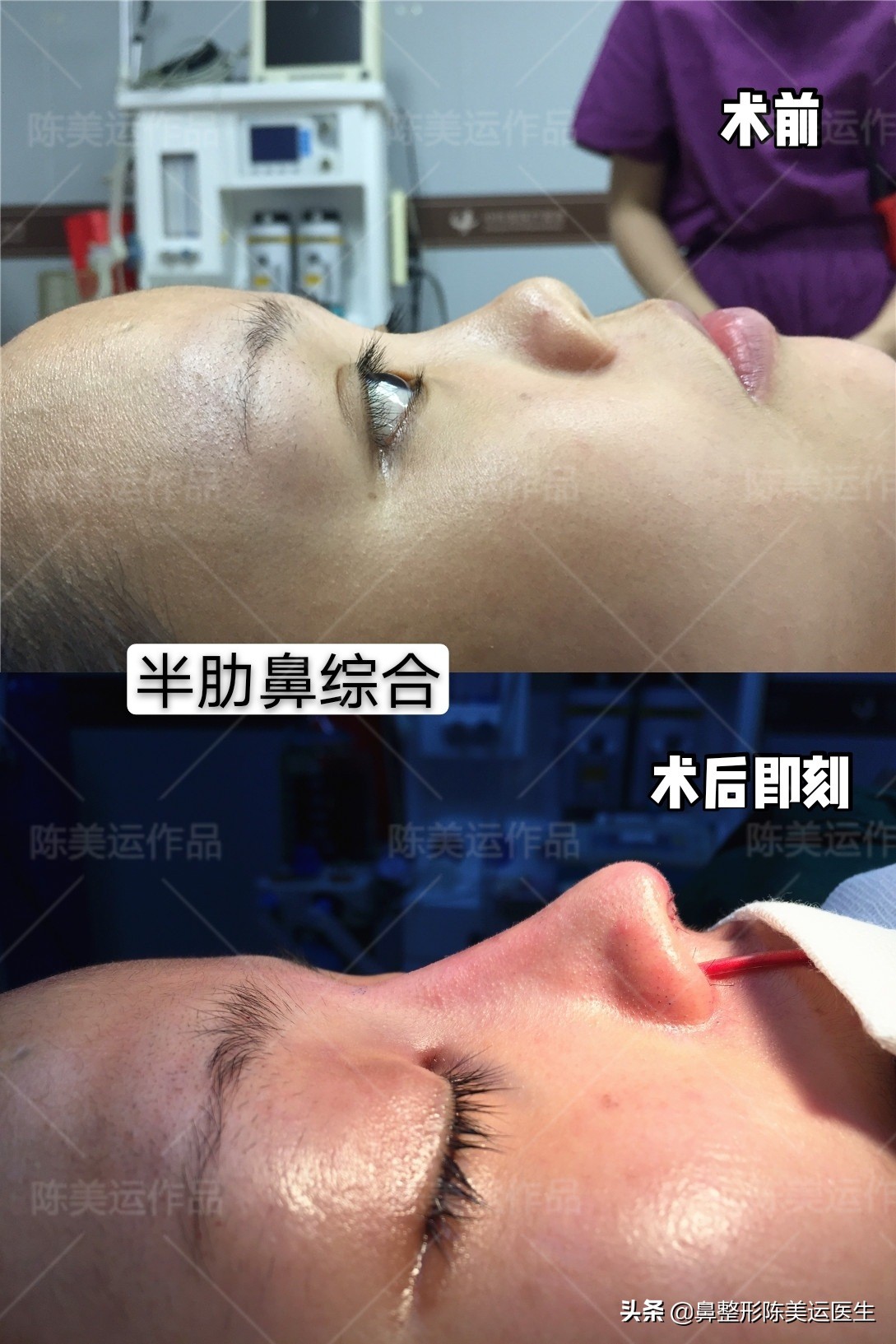 朝天鼻矫正难度大？难度有多大，效果就有多惊艳