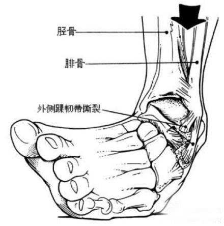 崴脚后只拍X光片行吗？为什么还有人拍核磁？有什么区别？