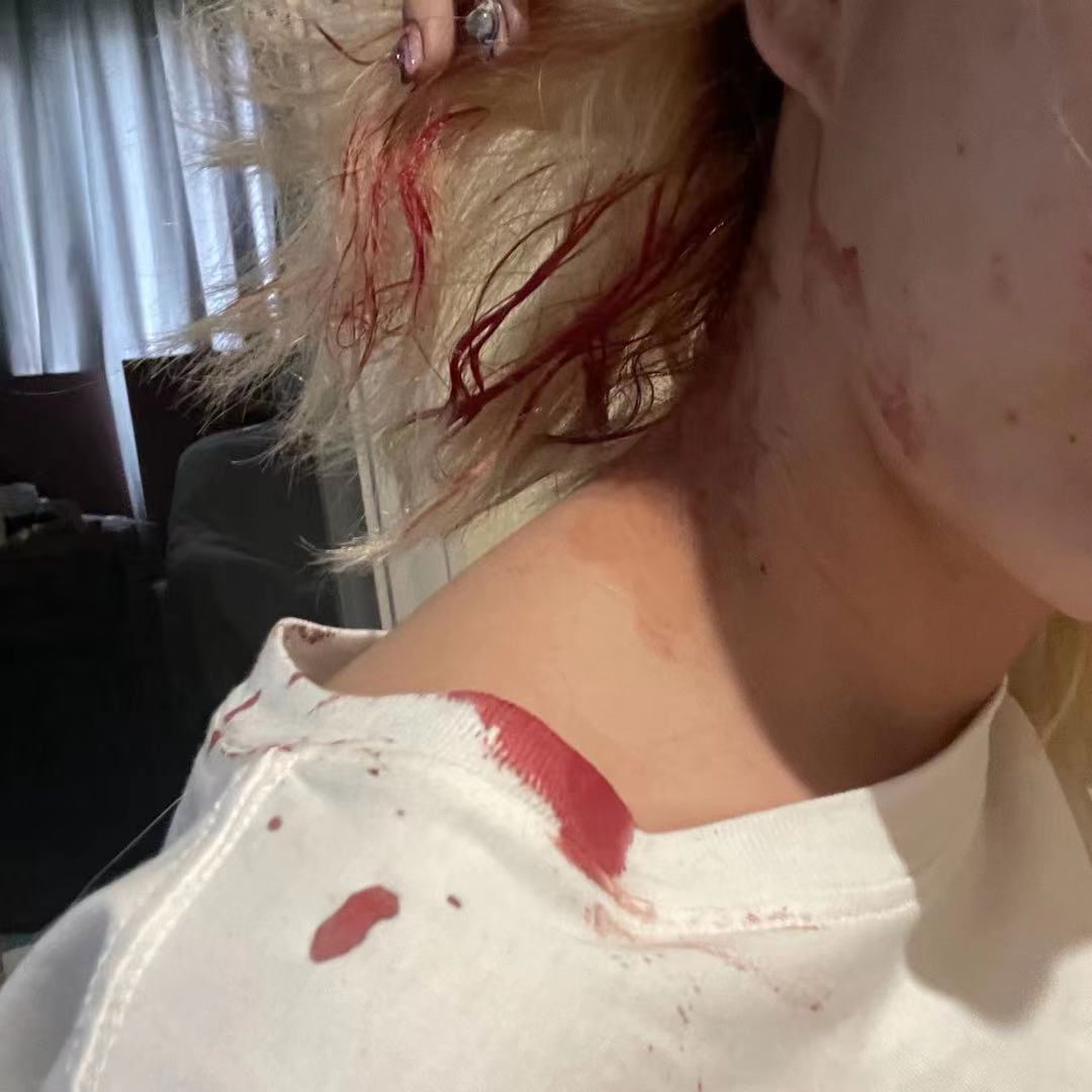 美女网红惨遭男友家暴,头部裂伤严重都是血,被邻居救后绝望发文