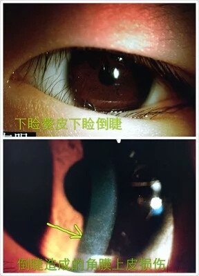 若经常感觉眼睛有异物感、流泪，有倒刺的感觉，那可能长倒睫毛了