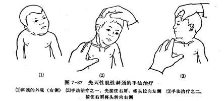 整脊治疗斜颈