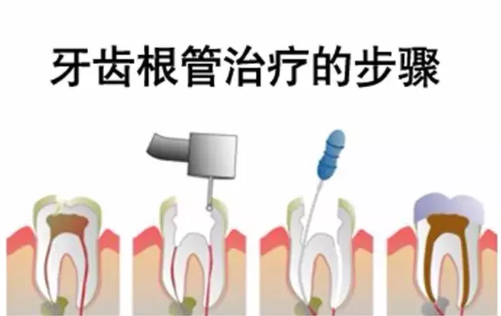 几十块钱就能补好的牙,久拖不治,以至要花上万,冤不冤?