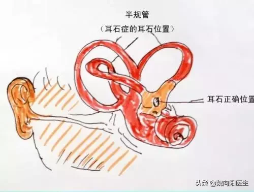眩晕不要怕，可能是耳石症发作。输液打针不可行，手法复位最有效