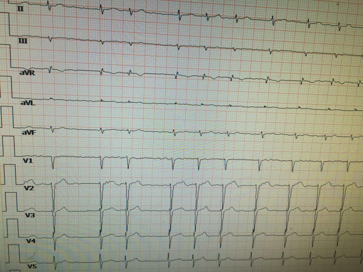什么是房颤？哪种治疗方法最好？